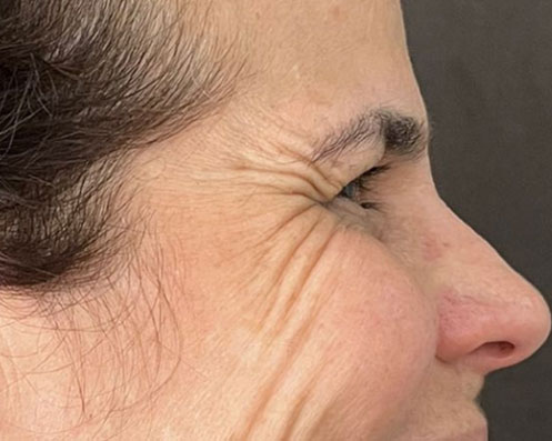 Antes - Toxina Botulínica