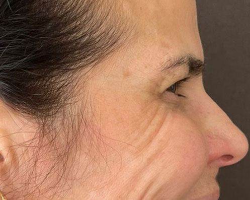 Depois - Toxina Botulínica