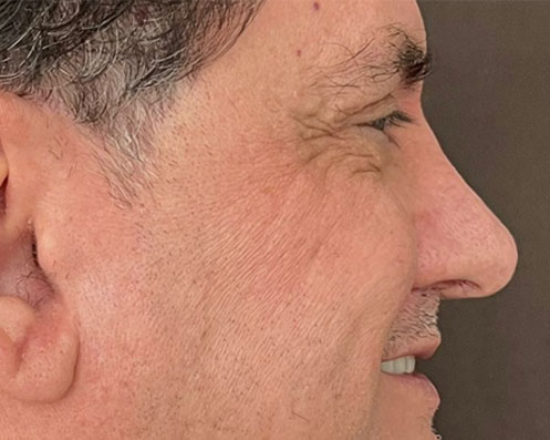 Antes - Rinomodelação com Ácido Hialurônico