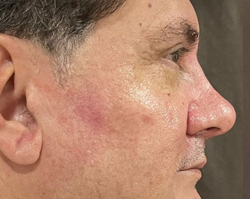 Depois - Rinomodelação com Ácido Hialurônico