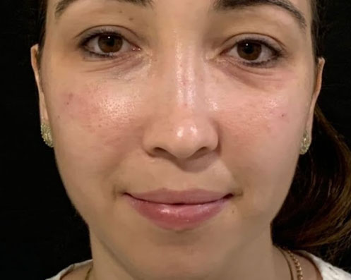 Antes - Bichectomia Definição Facial 