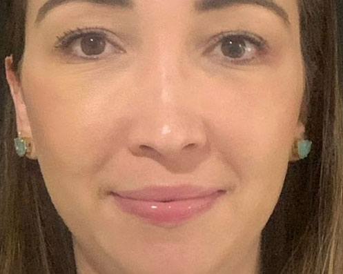 Depois - Bichectomia Definição Facial