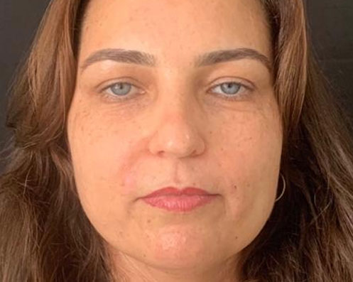 Antes - Bichectomia Definição Facial 