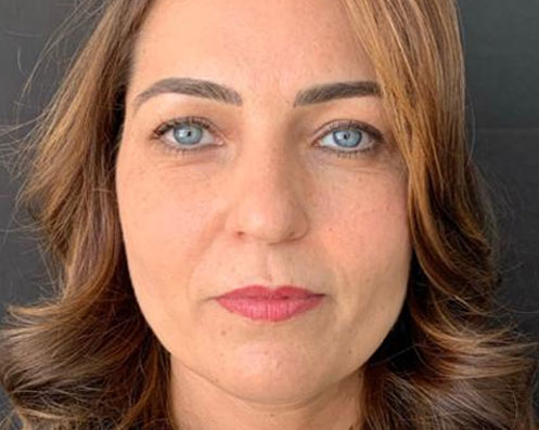 Depois - Bichectomia Definição Facial