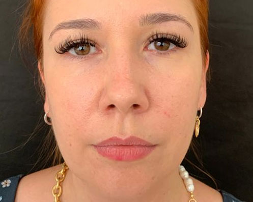 Antes - Bichectomia Definição Facial 