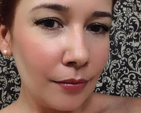 Depois - Bichectomia Definição Facial