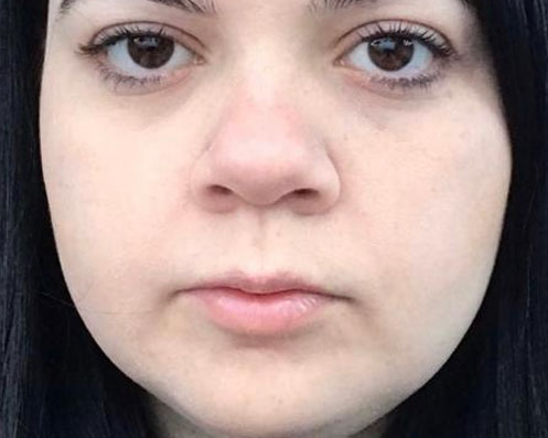 Antes - Bichectomia Definição Facial 