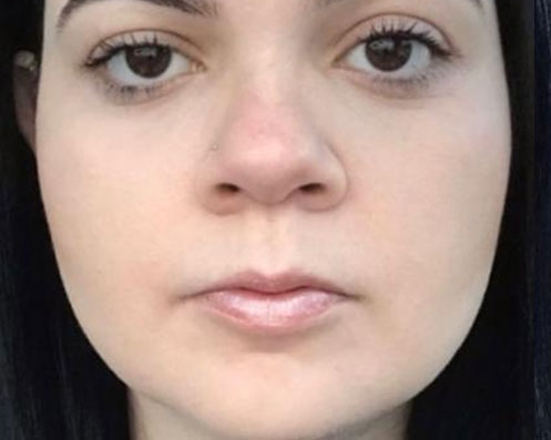 Depois - Bichectomia Definição Facial