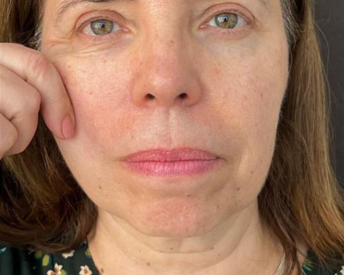 Depois - Bioestimuladores