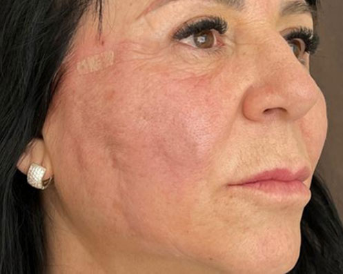 Depois - Fios de PDO