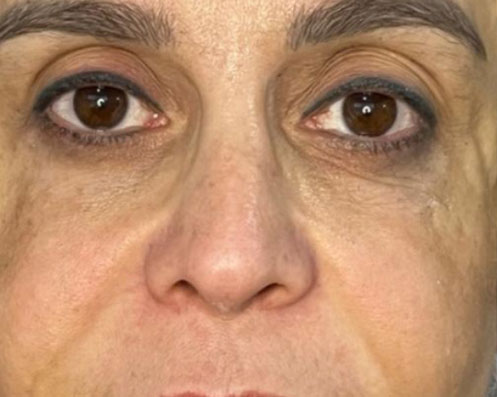 Antes - Harmonização Facial Completa