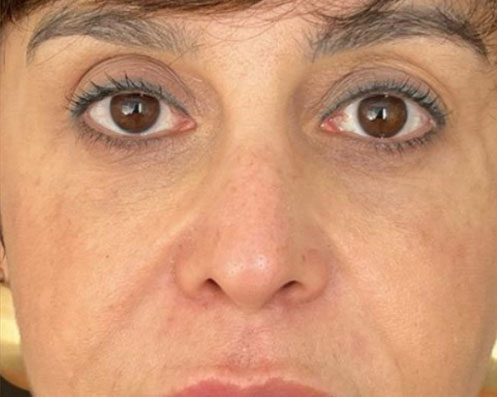 Depois - Harmonização Facial Completa