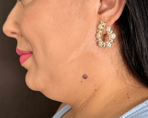 Antes - Lipoaspiração de Papada