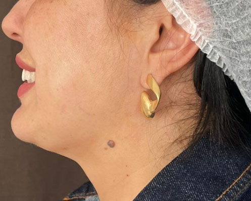 Depois - Lipoaspiração de Papada