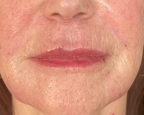 Depois - Microagulhamento