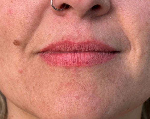 Antes - Preenchimento com Ácido Hialurônico