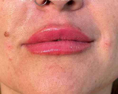 Depois - Preenchimento com Ácido Hialurônico